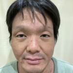 脱ステ3ヶ月後の写真